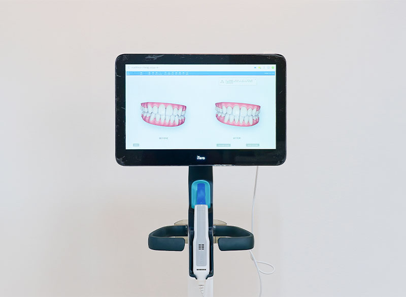 口腔内スキャナー（iTero）