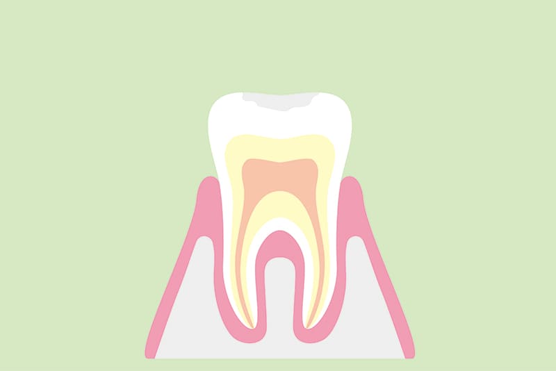 初期のむし歯（CO）
