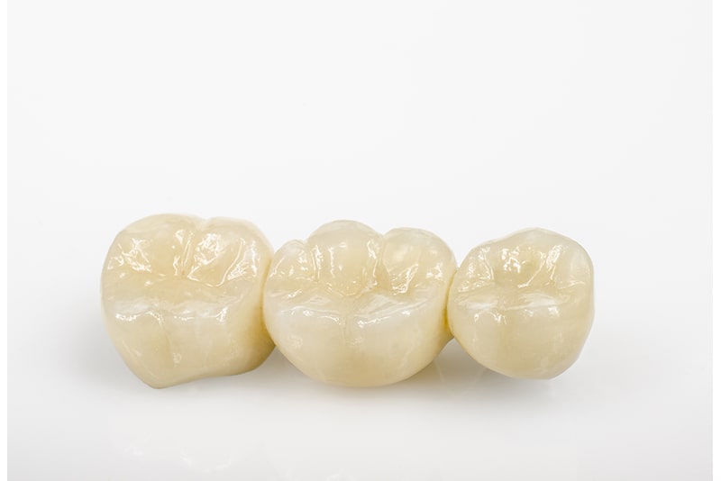 レジン（歯科用プラスチック）の詰め物・被せ物