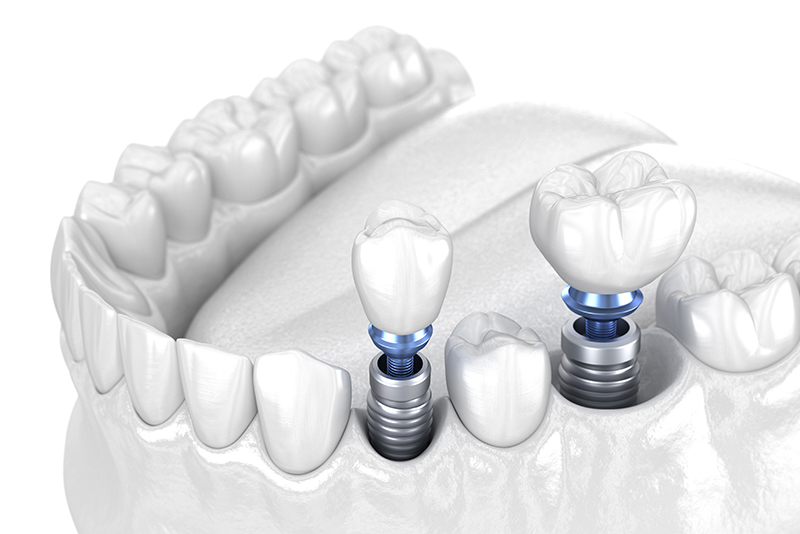 ストローマン公認インストラクターが在籍