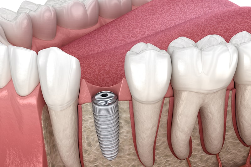 一次手術（インプラント体の埋入）