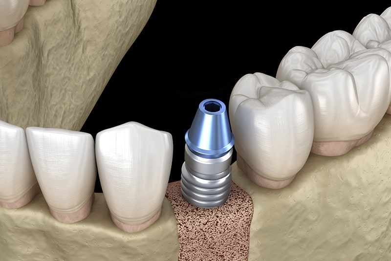 二次処置（土台の装着）