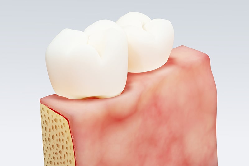 インプラント周囲炎