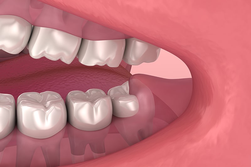 抜歯が必要な親知らずとは？