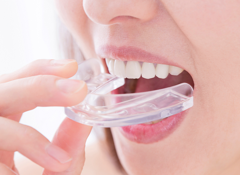 マウスピース製作