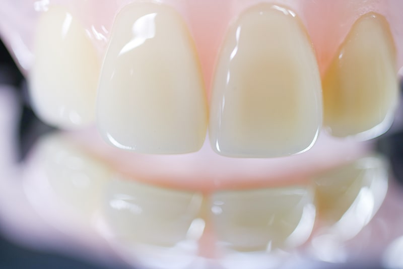 金属アレルギーへの配慮