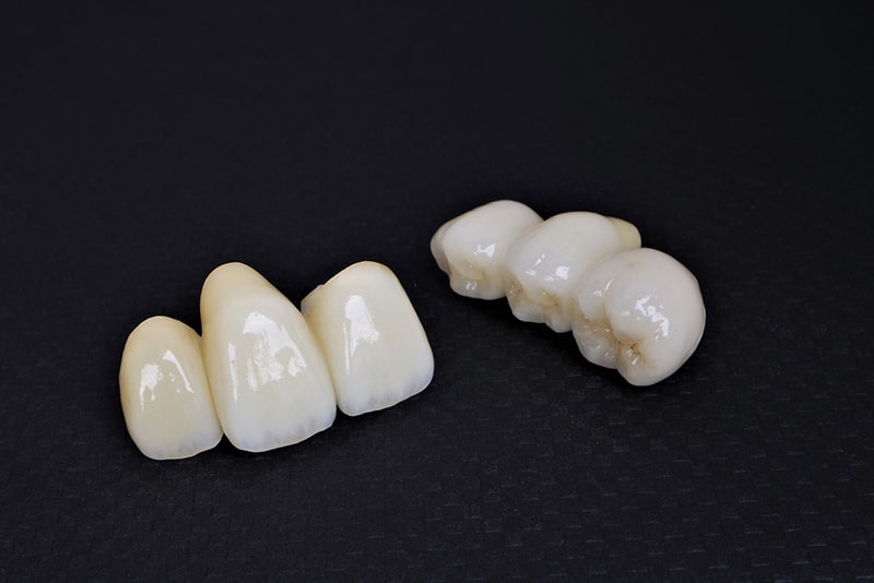 オールセラミック