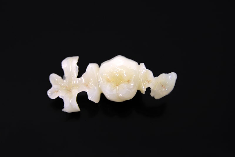 ハイブリッドインレー・クラウン